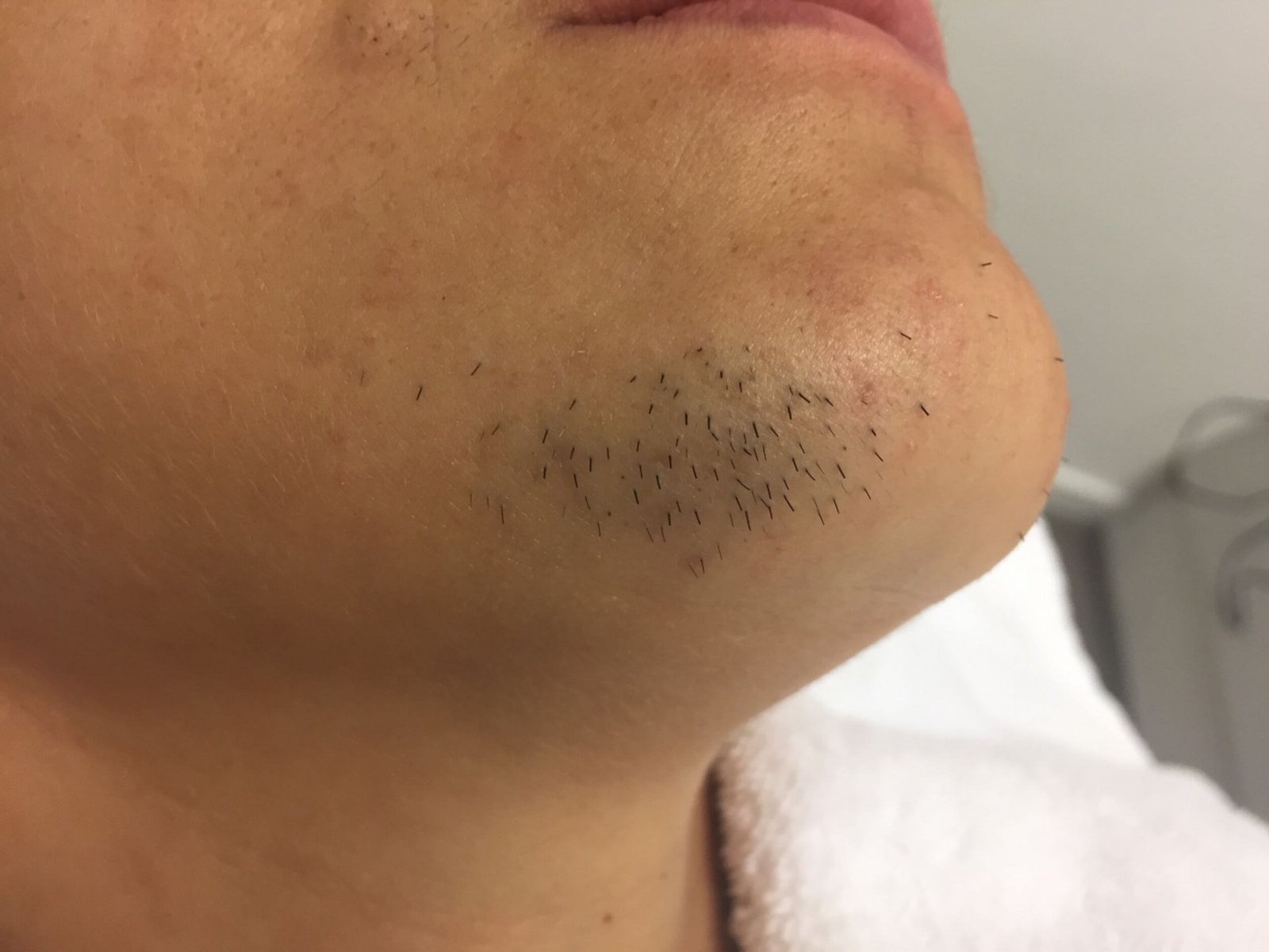 Quelle solution pour l’hirsutisme La thermolyse