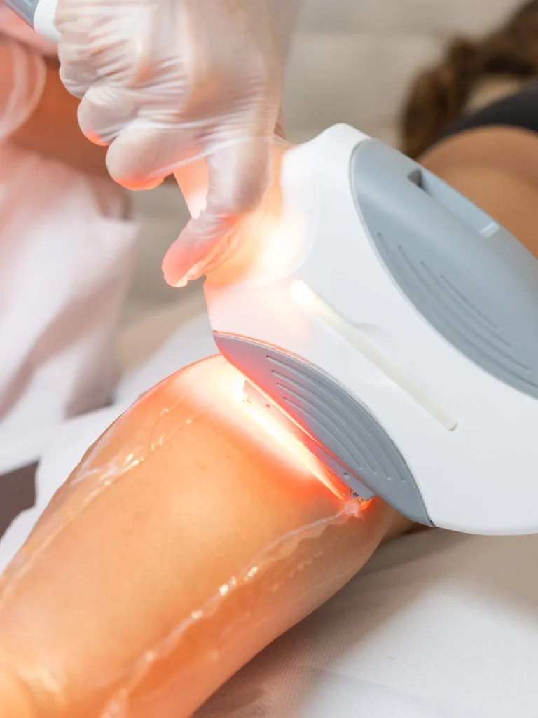 Epilation-définitive-lumiere pulsée
