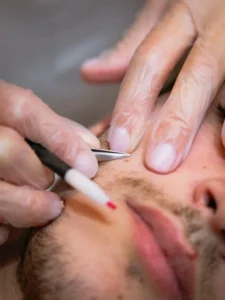 Epilation definitive a la thermolyse