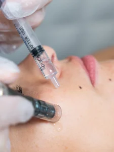 Microneedling régénération de peau