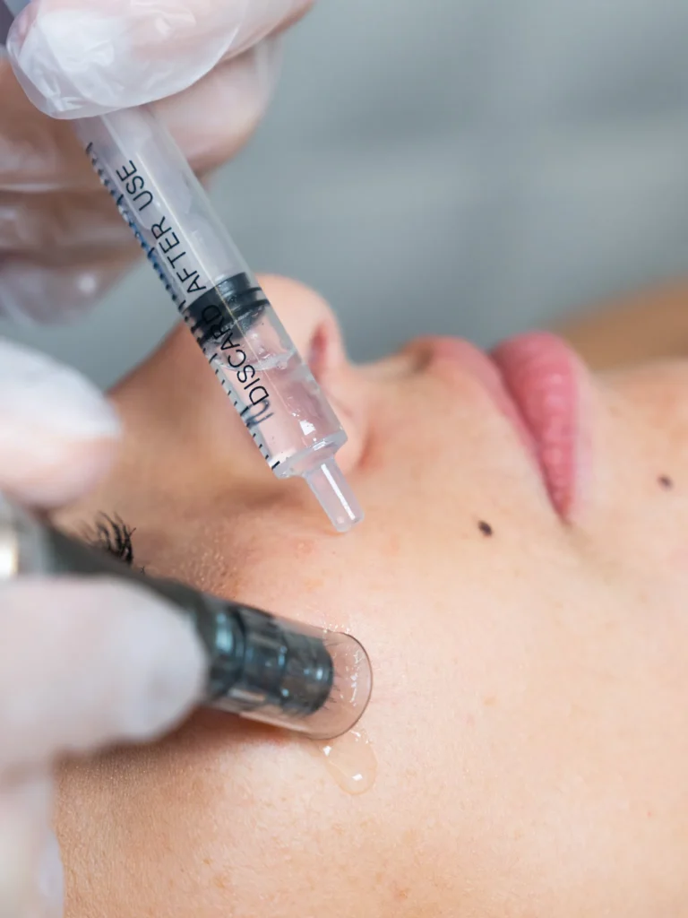 Microneedling régénération de peau