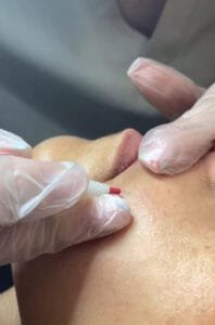 epilation electrolyse