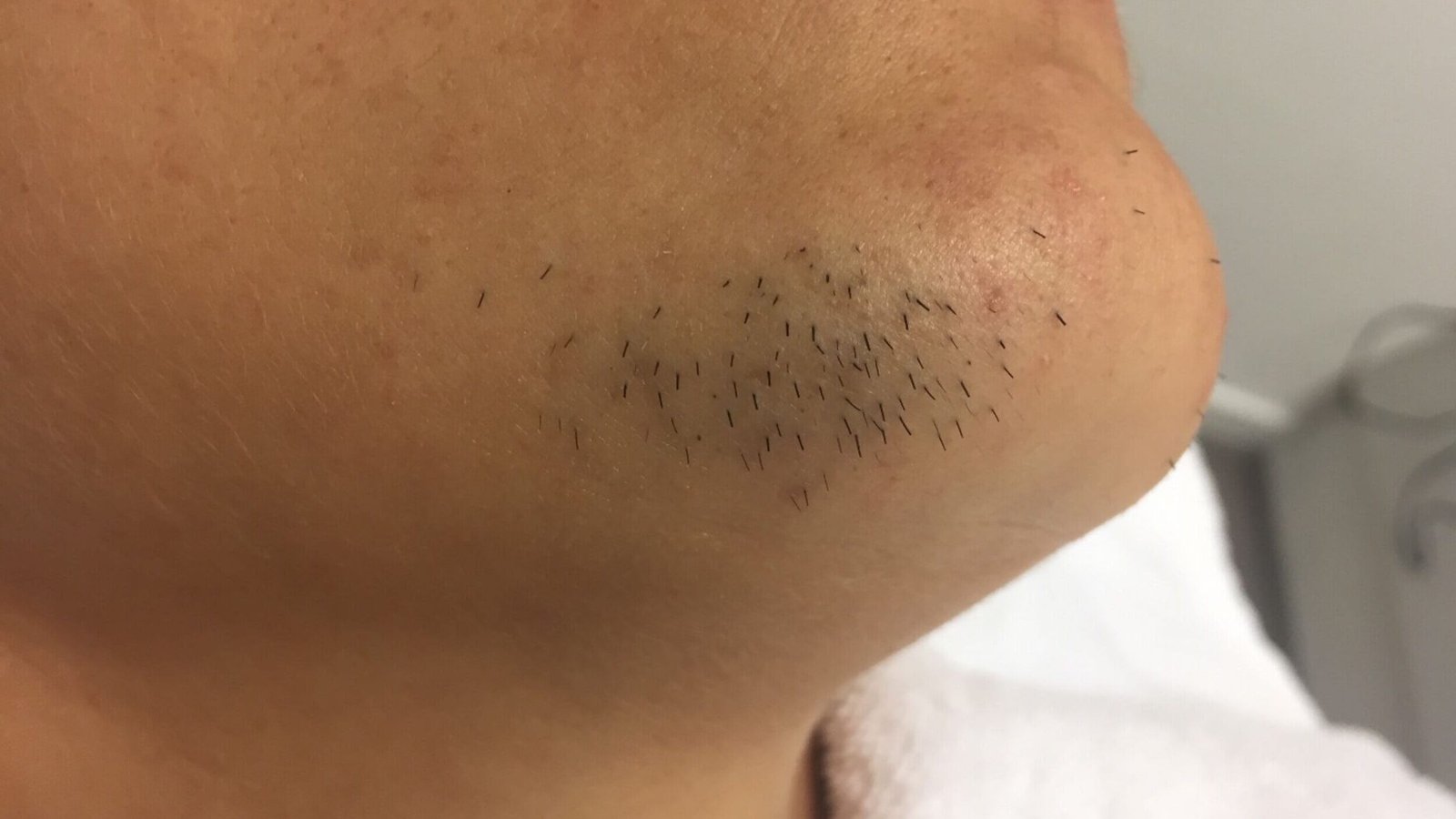 Quelle solution pour l’hirsutisme La thermolyse