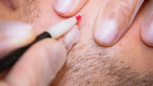 Thermolyse épilation définitive