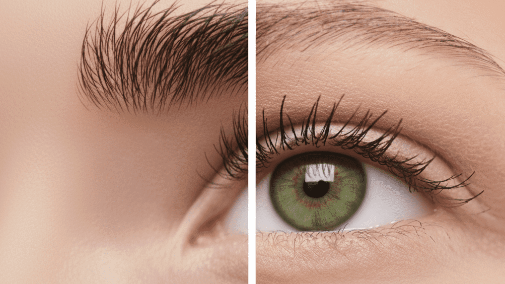 Avant après l'épilation définitive des sourcils par électrolyse