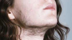 Comment enlever les poils SOPK grâce à l'électrolyse