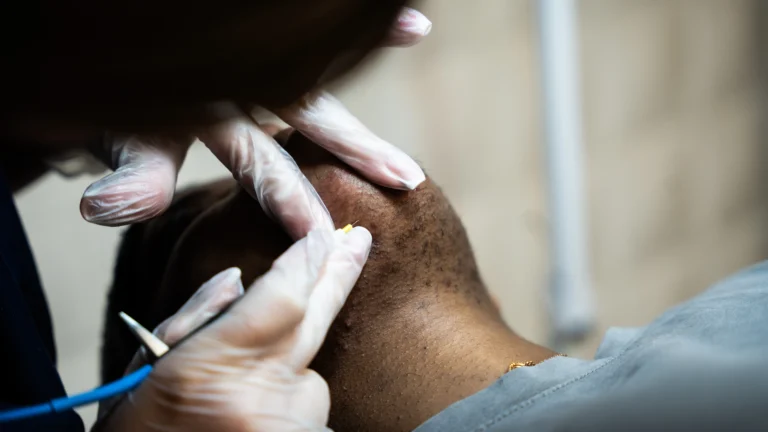 Freed épilation electrolyse thermolyse SOPK