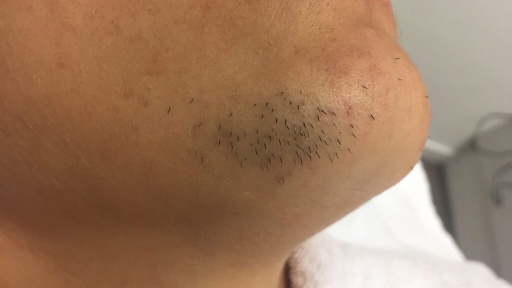 Quelle solution pour l’hirsutisme La thermolyse