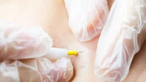 Épilation electrolyse a Paris