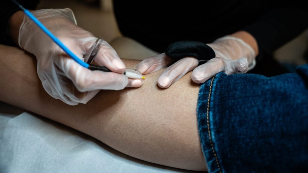 thermolyse Comment l'épilation thermolyse élimine les poils incarnés