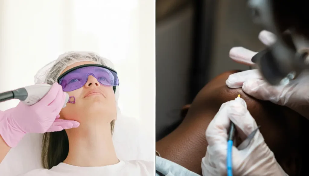 Thermolyse vs Laser peaux foncées