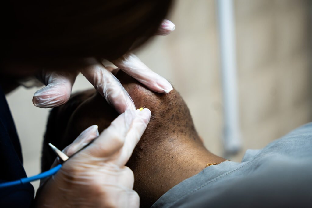 thermolyse adaptée aux peaux foncées ou bronzées garantit elle la sécurité