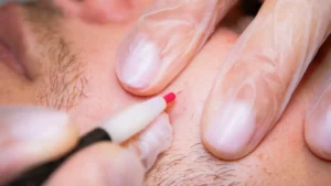 Thermolyse épilation définitive