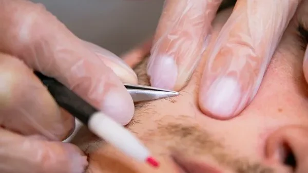 Epilation definitive a la thermolyse